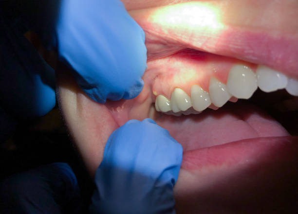 Best Emergency Dental Extractions in Geneseo, IL